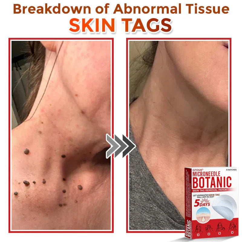 GFOUK® MicroNeedle Botanic Skin Tag Removal Patch