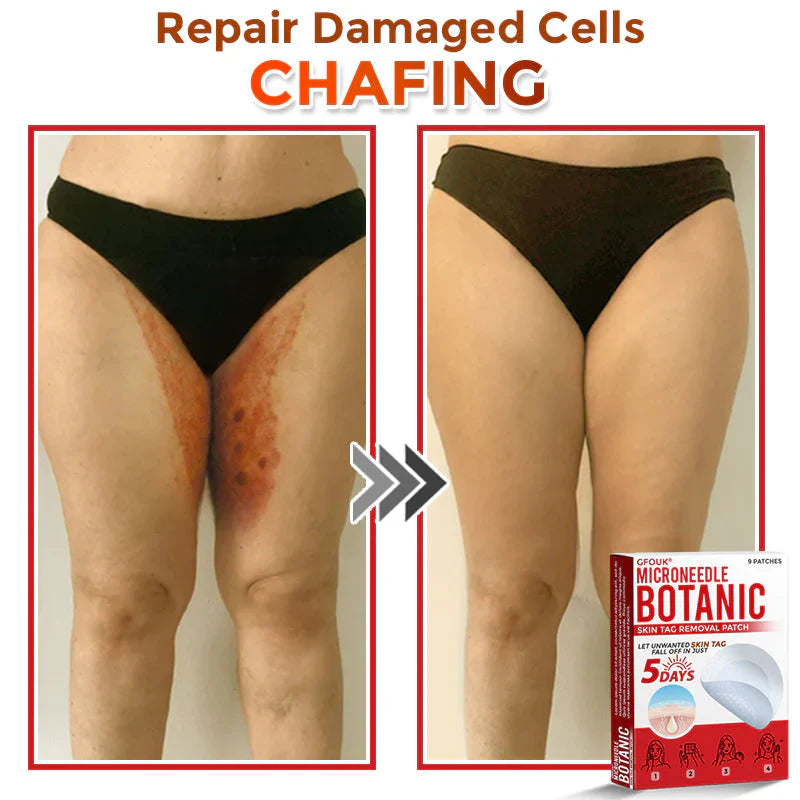 GFOUK® MicroNeedle Botanic Skin Tag Removal Patch