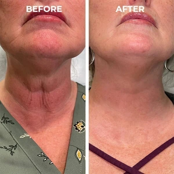 Last Day Promotion 50% OFF - 🔥Botox Face Serum