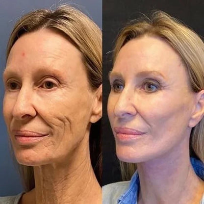 Last Day Promotion 50% OFF - 🔥Botox Face Serum