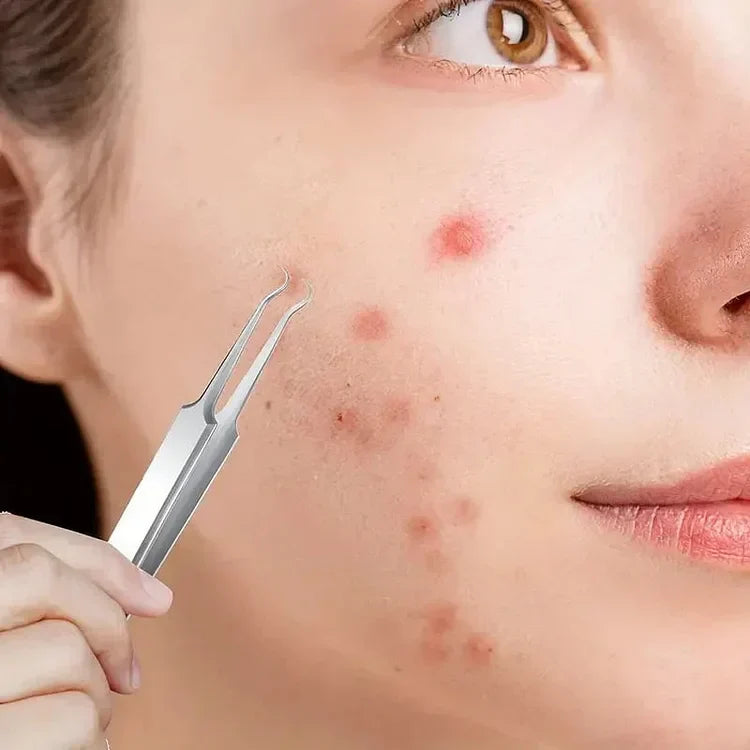 Professioneller Mitesserentferner