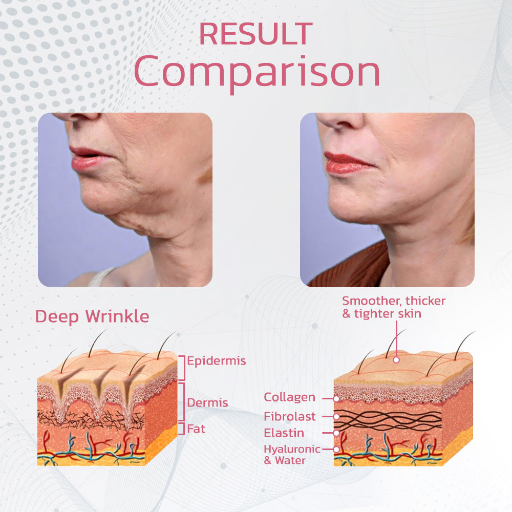 TENSPulse VFace Sleeping Beauty Gerät 