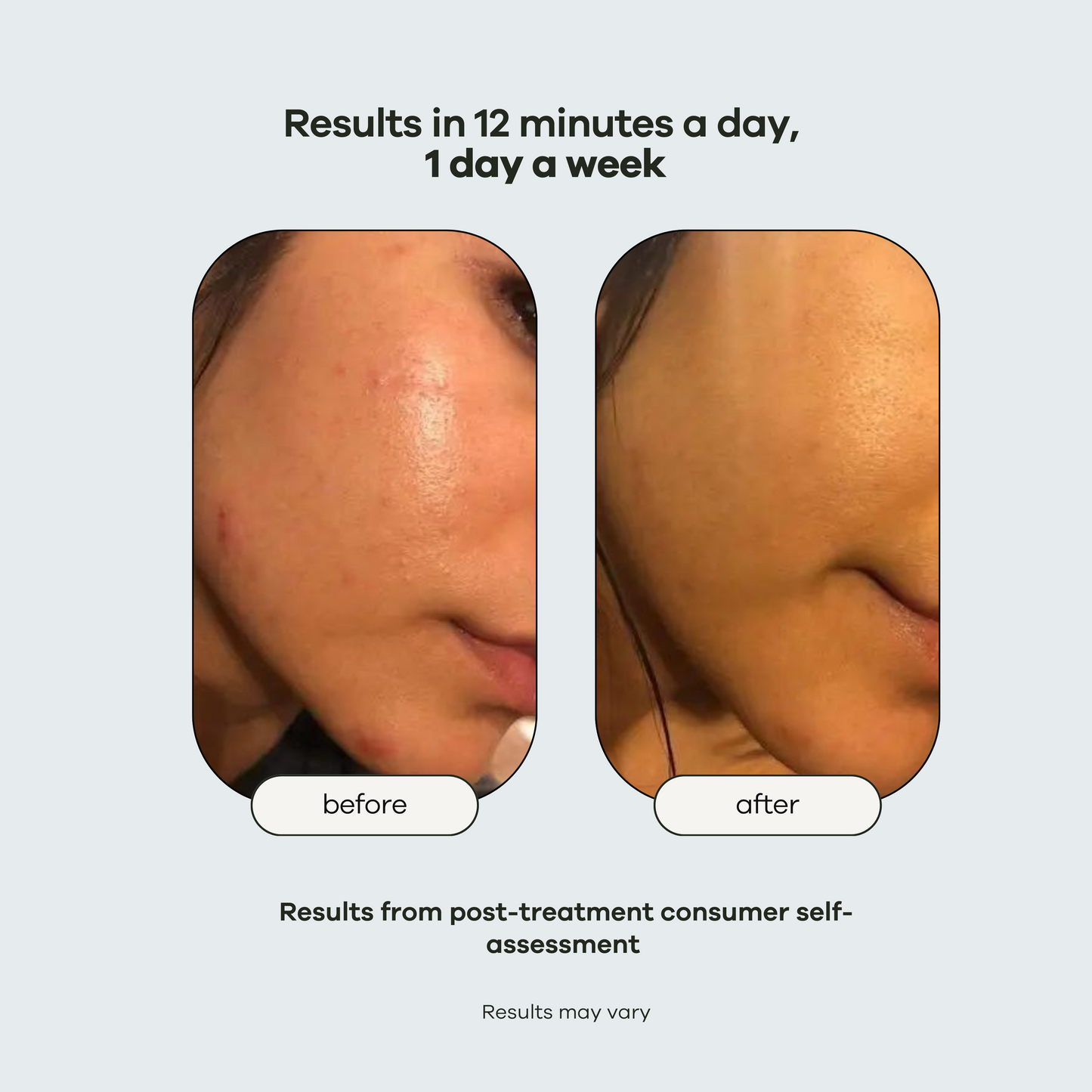 Pore Cleanse: Hydration Handset & Hydra Soothe Serum Kit