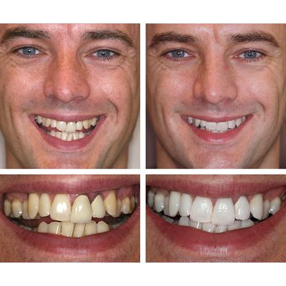 Esencia blanqueadora de dientes
