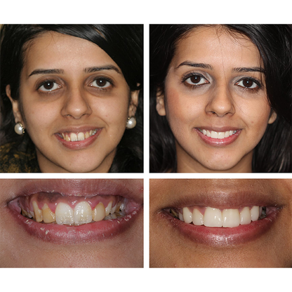 Esencia blanqueadora de dientes